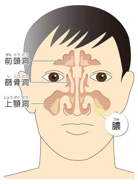 副鼻腔炎の原因