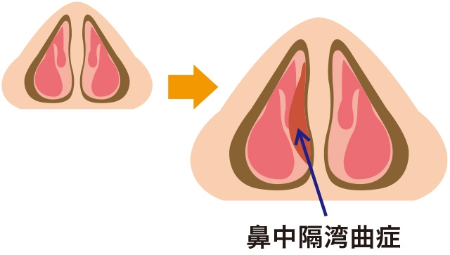 鼻中隔弯曲症の原因